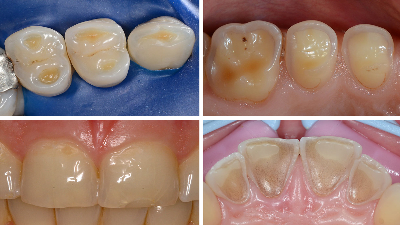Consensus report of the EFCD erosive tooth weardiagnosis and